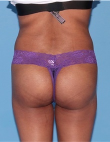 Buttock Lift with Augmentation After Photo by Siamak Agha, MD PhD FACS; Newport Beach, CA - Case 43919