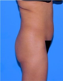 Buttock Lift with Augmentation Before Photo by Siamak Agha, MD PhD FACS; Newport Beach, CA - Case 43919