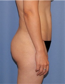 Buttock Lift with Augmentation After Photo by Siamak Agha, MD PhD FACS; Newport Beach, CA - Case 43920