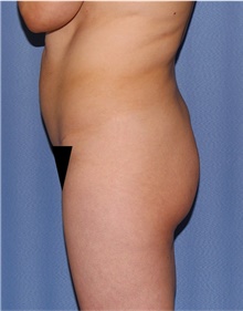 Buttock Lift with Augmentation Before Photo by Siamak Agha, MD PhD FACS; Newport Beach, CA - Case 43920