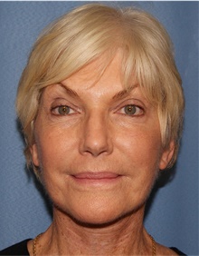 Facelift After Photo by Siamak Agha, MD; Newport Beach, CA - Case 43921