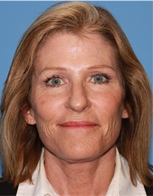 Facelift After Photo by Siamak Agha, MD; Newport Beach, CA - Case 43923