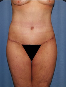 Body Lift After Photo by Siamak Agha, MD; Newport Beach, CA - Case 43982