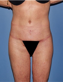 Body Lift After Photo by Siamak Agha, MD; Newport Beach, CA - Case 43989