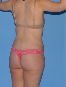 Body Contouring After Photo by Siamak Agha, MD PhD FACS; Newport Beach, CA - Case 43993