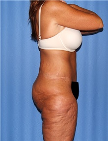 Body Contouring Before Photo by Siamak Agha, MD; Newport Beach, CA - Case 43995
