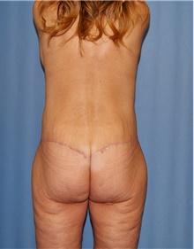 Body Contouring After Photo by Siamak Agha, MD; Newport Beach, CA - Case 43995