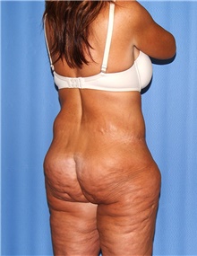 Body Contouring Before Photo by Siamak Agha, MD; Newport Beach, CA - Case 43995