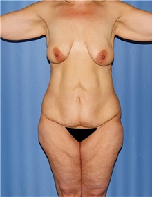 Body Contouring Before Photo by Siamak Agha, MD PhD FACS; Newport Beach, CA - Case 43996