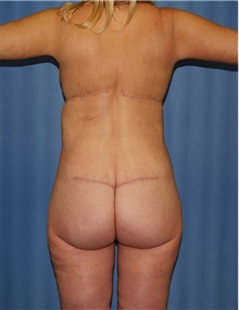 Body Contouring After Photo by Siamak Agha, MD PhD FACS; Newport Beach, CA - Case 43996