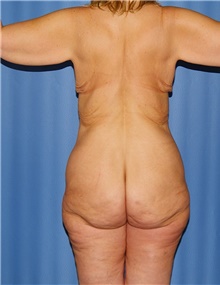 Body Contouring Before Photo by Siamak Agha, MD PhD FACS; Newport Beach, CA - Case 43996