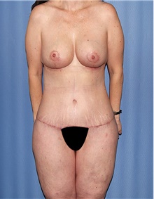 Body Contouring After Photo by Siamak Agha, MD PhD FACS; Newport Beach, CA - Case 43997