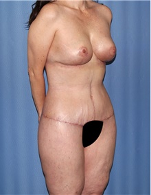 Body Contouring After Photo by Siamak Agha, MD PhD FACS; Newport Beach, CA - Case 43997