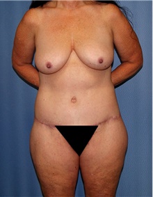 Body Contouring After Photo by Siamak Agha, MD PhD FACS; Newport Beach, CA - Case 43998