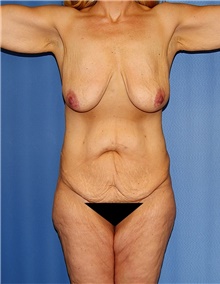 Body Contouring Before Photo by Siamak Agha, MD PhD FACS; Newport Beach, CA - Case 43999