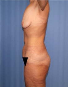 Body Contouring Before Photo by Siamak Agha, MD PhD FACS; Newport Beach, CA - Case 44000