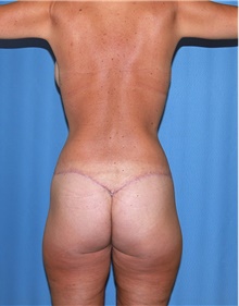 Body Contouring After Photo by Siamak Agha, MD PhD FACS; Newport Beach, CA - Case 44000