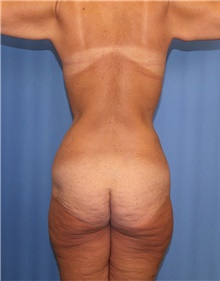 Body Contouring Before Photo by Siamak Agha, MD PhD FACS; Newport Beach, CA - Case 44000