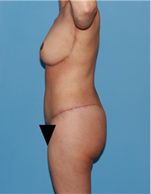 Body Contouring After Photo by Siamak Agha, MD PhD FACS; Newport Beach, CA - Case 44001