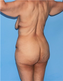 Body Contouring Before Photo by Siamak Agha, MD PhD FACS; Newport Beach, CA - Case 44001
