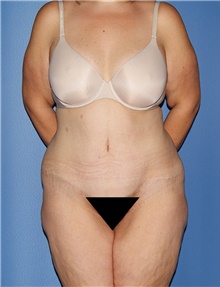 Body Contouring Before Photo by Siamak Agha, MD; Newport Beach, CA - Case 44003