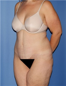 Body Contouring Before Photo by Siamak Agha, MD PhD FACS; Newport Beach, CA - Case 44003