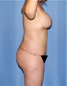 Body Contouring After Photo by Siamak Agha, MD PhD FACS; Newport Beach, CA - Case 44003