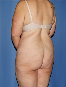 Body Contouring Before Photo by Siamak Agha, MD PhD FACS; Newport Beach, CA - Case 44003