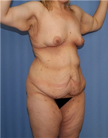 Body Contouring Before Photo by Siamak Agha, MD PhD FACS; Newport Beach, CA - Case 44004
