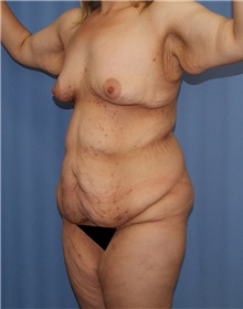 Body Contouring Before Photo by Siamak Agha, MD PhD FACS; Newport Beach, CA - Case 44004
