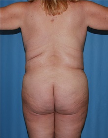 Body Contouring Before Photo by Siamak Agha, MD PhD FACS; Newport Beach, CA - Case 44005
