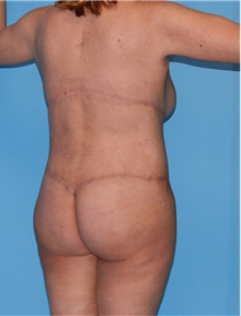 Body Contouring After Photo by Siamak Agha, MD PhD FACS; Newport Beach, CA - Case 44005