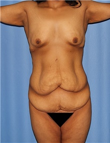 Body Contouring Before Photo by Siamak Agha, MD PhD FACS; Newport Beach, CA - Case 44006