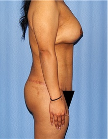 Body Contouring After Photo by Siamak Agha, MD PhD FACS; Newport Beach, CA - Case 44006