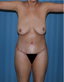 Body Contouring After Photo by Siamak Agha, MD; Newport Beach, CA - Case 44007
