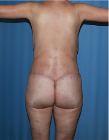 Body Contouring After Photo by Siamak Agha, MD PhD FACS; Newport Beach, CA - Case 44007