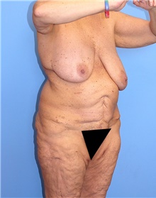 Body Contouring Before Photo by Siamak Agha, MD PhD FACS; Newport Beach, CA - Case 44011