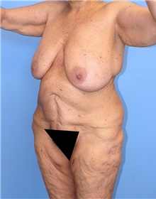Body Contouring Before Photo by Siamak Agha, MD PhD FACS; Newport Beach, CA - Case 44011