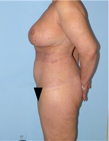 Body Contouring After Photo by Siamak Agha, MD PhD FACS; Newport Beach, CA - Case 44011