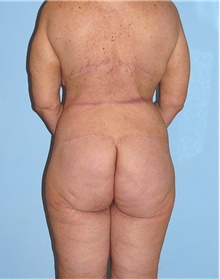 Body Contouring After Photo by Siamak Agha, MD PhD FACS; Newport Beach, CA - Case 44011