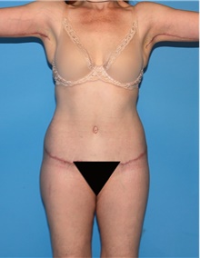Body Contouring After Photo by Siamak Agha, MD PhD FACS; Newport Beach, CA - Case 44018