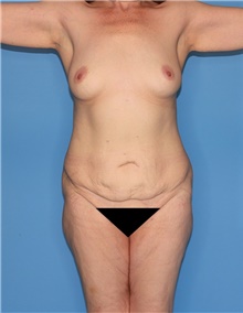 Body Contouring Before Photo by Siamak Agha, MD; Newport Beach, CA - Case 44018