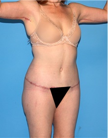 Body Contouring After Photo by Siamak Agha, MD PhD FACS; Newport Beach, CA - Case 44018