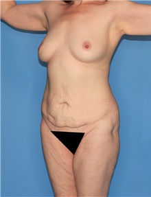 Body Contouring Before Photo by Siamak Agha, MD PhD FACS; Newport Beach, CA - Case 44018
