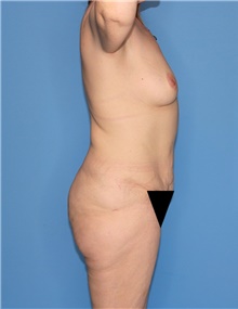 Body Contouring Before Photo by Siamak Agha, MD PhD FACS; Newport Beach, CA - Case 44018