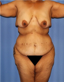 Body Contouring Before Photo by Siamak Agha, MD PhD FACS; Newport Beach, CA - Case 44026