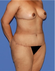 Body Contouring After Photo by Siamak Agha, MD PhD FACS; Newport Beach, CA - Case 44026