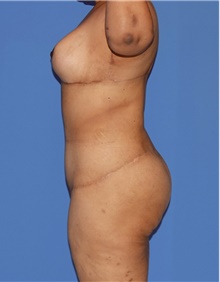 Body Contouring After Photo by Siamak Agha, MD PhD FACS; Newport Beach, CA - Case 44026