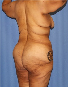 Body Contouring Before Photo by Siamak Agha, MD PhD FACS; Newport Beach, CA - Case 44026
