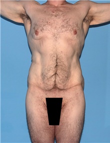 Body Contouring Before Photo by Siamak Agha, MD; Newport Beach, CA - Case 44031